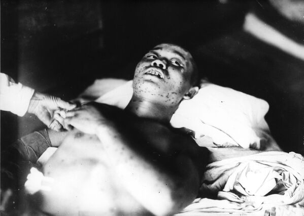 جندي، 21 عاما، تعرض لقصف القنبلة الذرية في مدينة هيروشيما يوم 6 أغسطس/ آب 1945 - سبوتنيك عربي