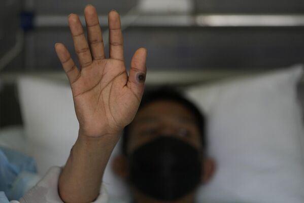 مريض يظهر يديه مصابة بقرحة ناجمة عن جدري القرود في مستشفى أرزوبيسبو لوايزا في ليما، بيرو، يوم 16 أغسطس 2022. - سبوتنيك عربي