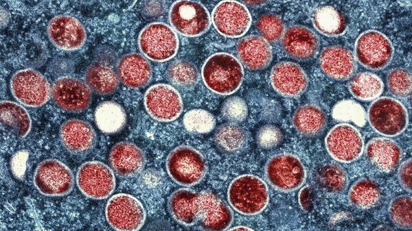 صورة ملونة بالمجهر الإلكتروني تظهر جزيئات جدري القرود باللون الأحمر الموجودة داخل الخلية المصابة باللون الأزرق - سبوتنيك عربي