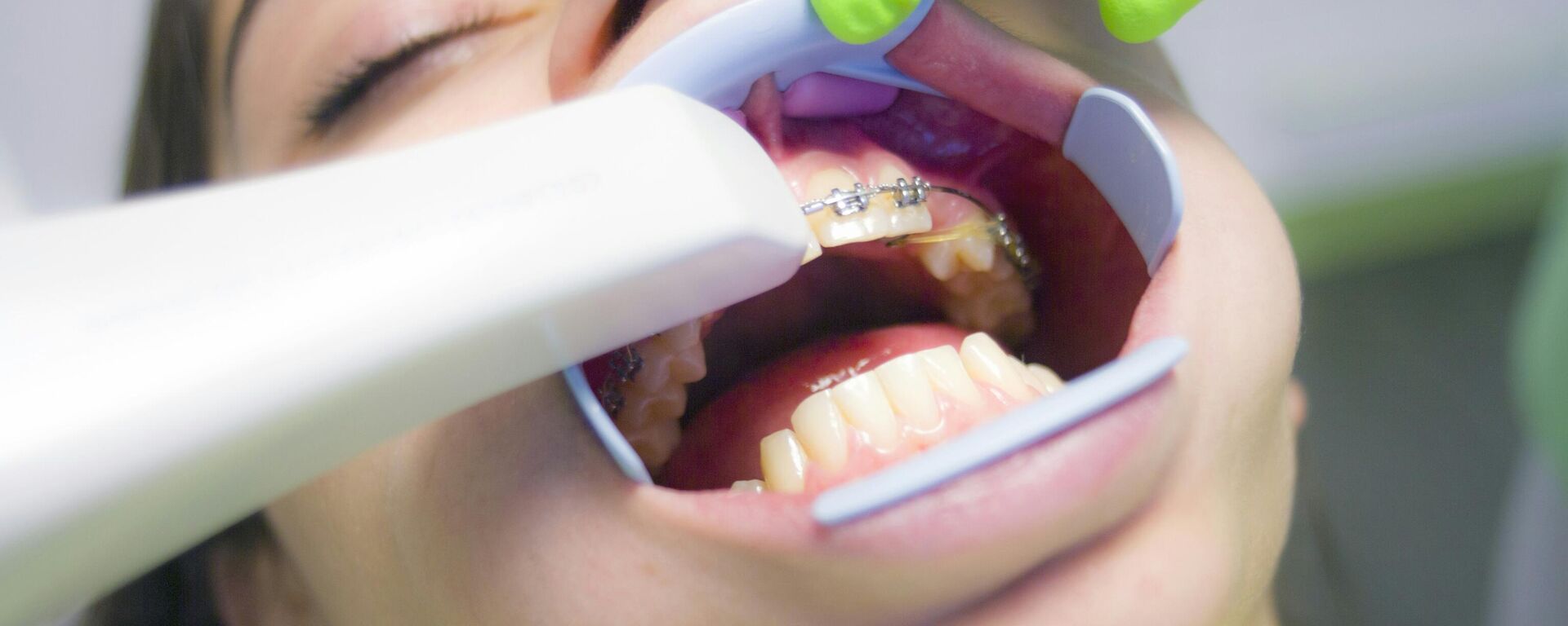 طبيب يعاين جهاز تقوم أسنان بعد تركيبه لمريضة  - سبوتنيك عربي, 1920, 11.03.2024