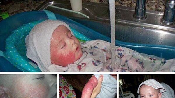 طفل يعاني من مرض جلدي - سبوتنيك عربي