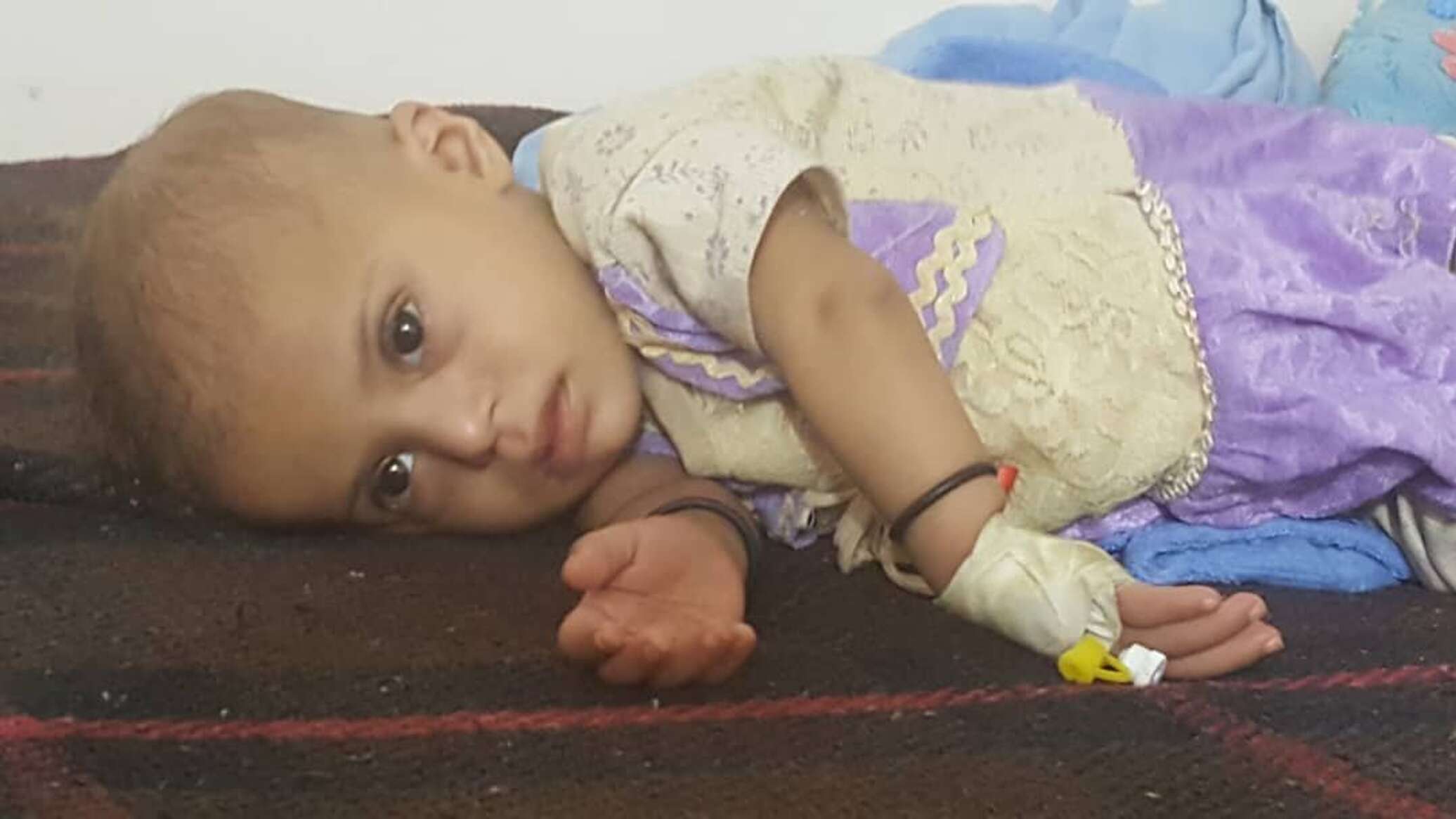"الصحة العالمية" تعلن تفشي شلل الأطفال والحصبة في اليمن