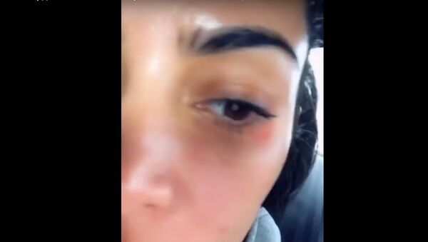 بالفيديو... كيم كارداشيان تكشف عن مرض في وجهها - سبوتنيك عربي