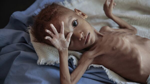 فتى يعاني من الكوليرا سوء التغذية الحاد يقع على سرير في مستشفى في مركز صحي في حجة باليمن - سبوتنيك عربي