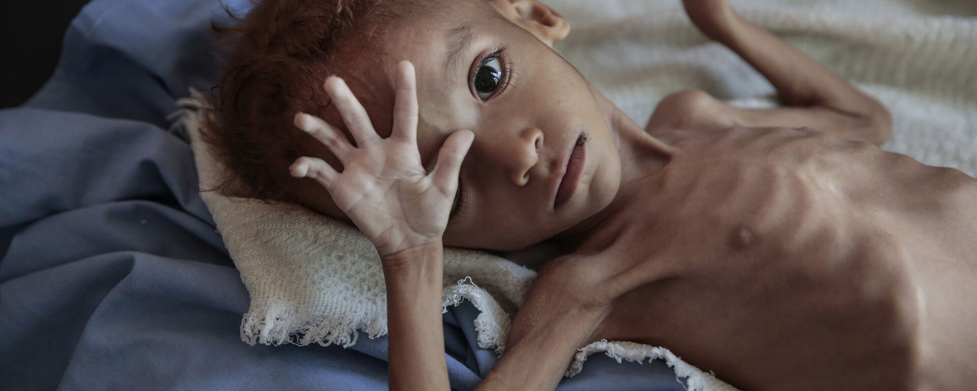 فتى يعاني من الكوليرا سوء التغذية الحاد يقع على سرير في مستشفى في مركز صحي في حجة باليمن - سبوتنيك عربي, 1920, 29.06.2021