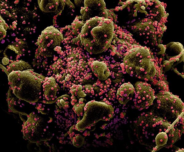 مسح إلكتروني لخلية في حالة الاستماتة (باللون البني المخضر) لمريض مصاب جداً بجزيئات فيروس SARS-COV-2 (باللون الوردي)، والمعروف أيضًا باسم فيروس تاجي جديد كورونا. - سبوتنيك عربي
