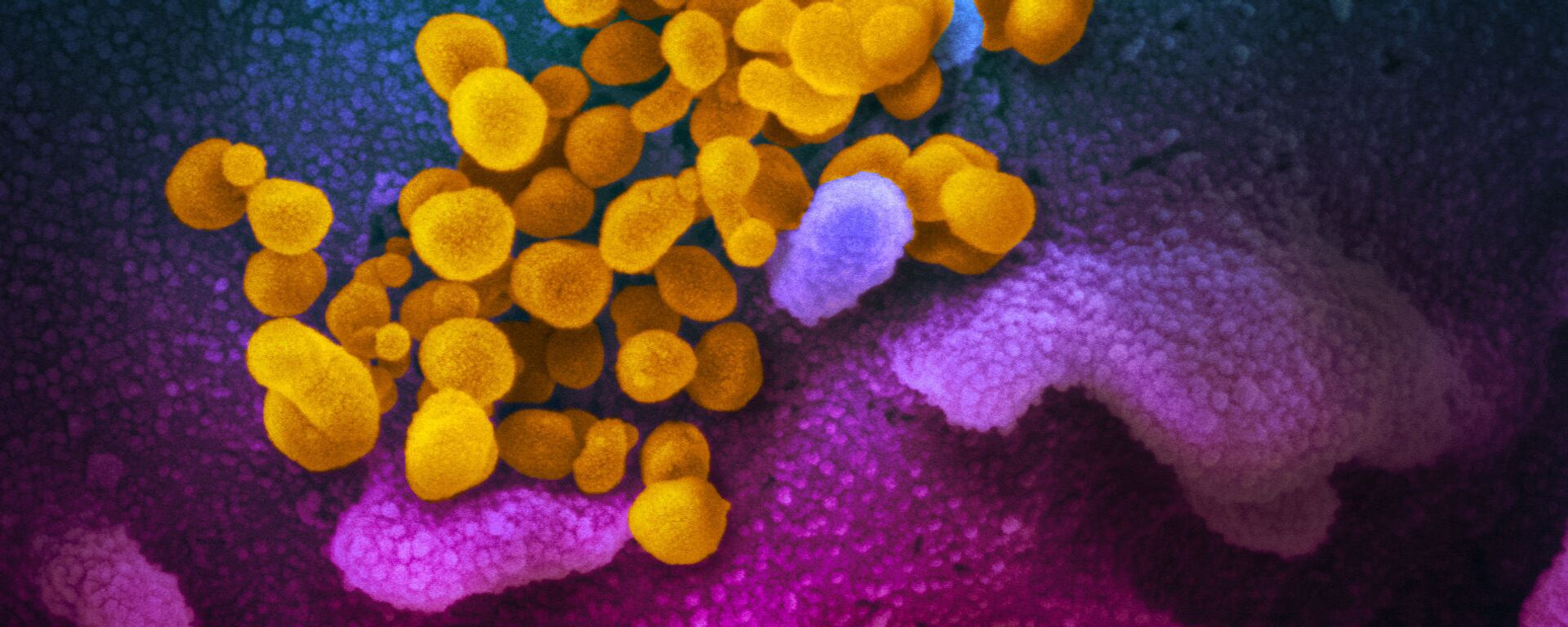 صورة مجهرية إلكترونية لعينة من مريض، لجزيئات فيروس SARS-COV-2 (باللون الأصفر)، والمعروفة أيضًا باسم الفيروس التاجي الجديد كورونا، الفيروس الذي يسبب مرض Covid-19. - سبوتنيك عربي, 1920, 12.09.2021