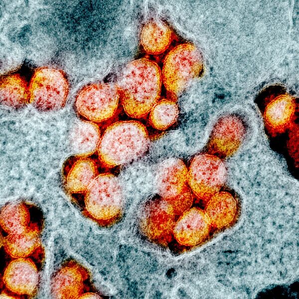 صورة مجهرية إلكترونية لعينة من مريض، لجزيئات فيروس SARS-COV-2، والمعروفة أيضًا باسم الفيروس التاجي الجديد كورونا، الفيروس الذي يسبب مرض Covid-19. - سبوتنيك عربي