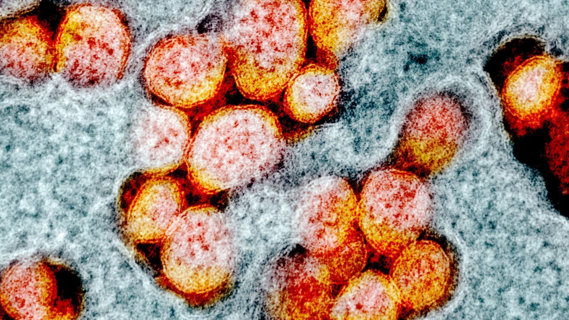 صورة مجهرية إلكترونية لعينة من مريض، لجزيئات فيروس SARS-COV-2، والمعروفة أيضًا باسم الفيروس التاجي الجديد كورونا، الفيروس الذي يسبب مرض Covid-19. - سبوتنيك عربي, 1920, 25.08.2021