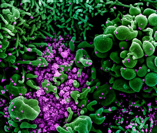 مسح إلكتروني لخلية في حالة الاستماتة (باللون الأخضر) لمريض مصاب جداً بجزيئات فيروس SARS-COV-2 (باللون البنفسجي)، والمعروف أيضًا باسم فيروس تاجي جديد كورونا. - سبوتنيك عربي